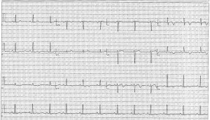 EKG July 2014