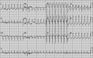 ekg-wct