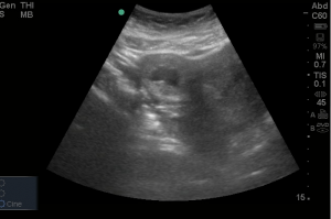 ectopic preg