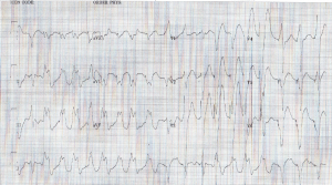 ekg sept 2014