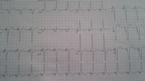 second ekg sept