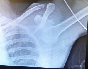 shoulder dislocation