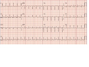 nov ekg