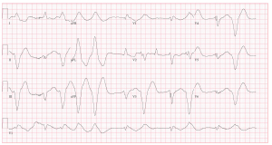 ECGblogPostcase