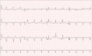 RBBB w/ LAFB & 1st degree AV block and inferior q-waves