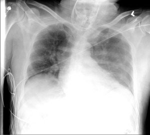 cxr 1