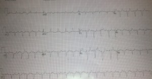 feb2015 ekg