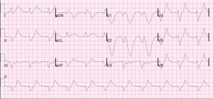 sinusoidal ekg