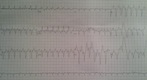 ecgfebpreadenosine