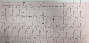 ekg-march