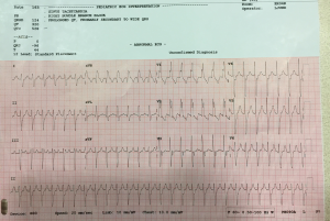 ECG.Belhassen