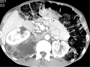 psoas abscess