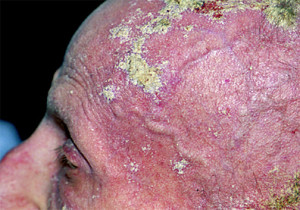 Crusted_scabies_scalp