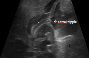 antral nipple