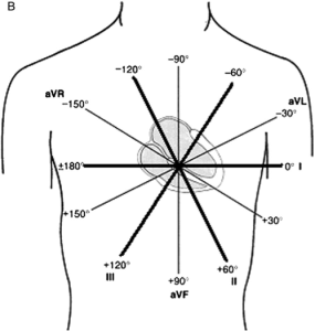 The combination of unipolar and bipolar limb leads allowed for higher detailed EKGs along the frontal plane