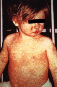 measles