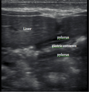 normal pylorus