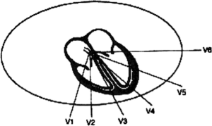 Frank Wilson's unipolar precordial leads allowed for a horizontal plane of detection and increased sensitivity for ischemic events