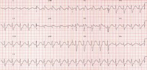 tca toxicity ekg