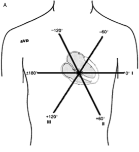 "Einthoven's triangle" were the first clinically used EKG leads. They were bipolar. 