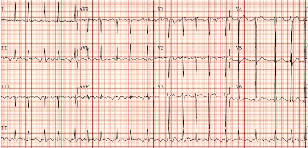 unspecified atrial flutter icd 10