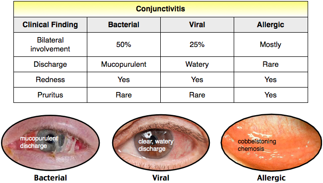 Image bacterial viral allergic conjunctivitis County EM