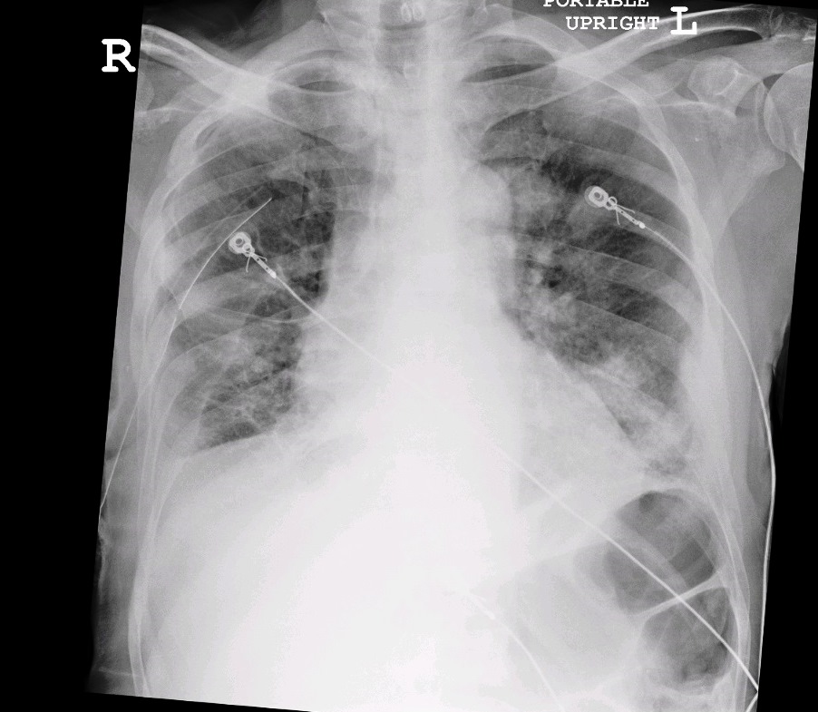 CXR2 - County EM