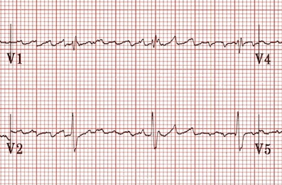 regularised-AF - County EM