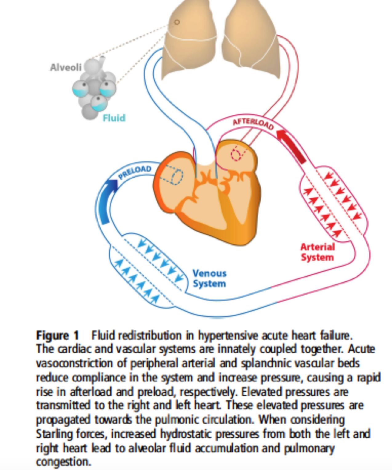 Acute Cardiogenic Pulmonary Edema - A Complete Review Of "flash ...