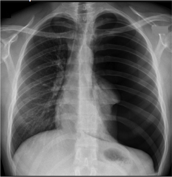 CXR Pneumo - County EM