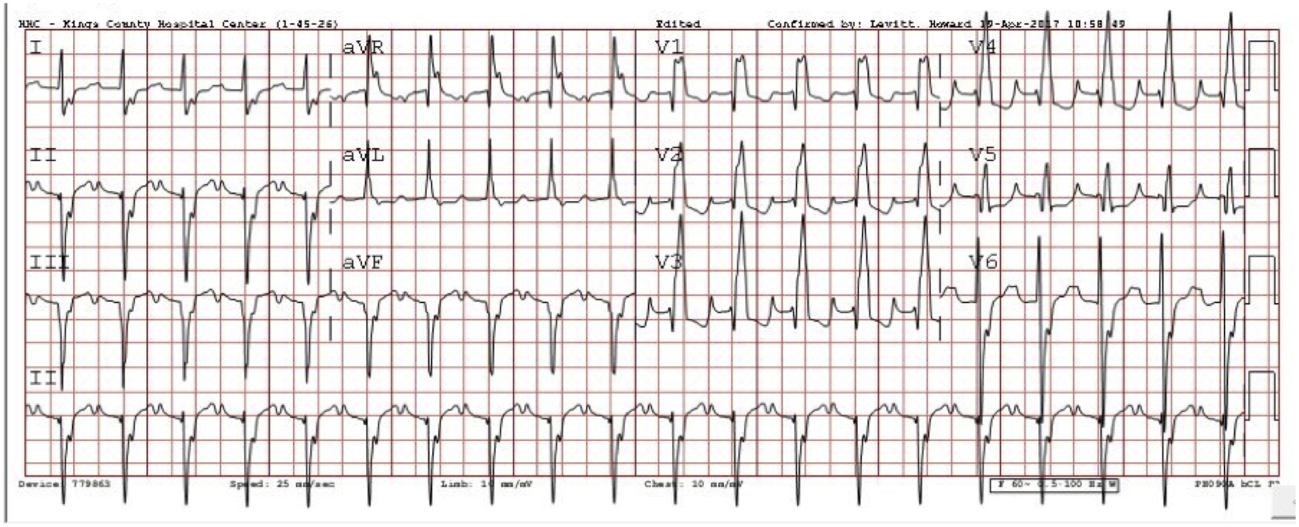 Rhythm Nation July Answer: Cerebral T Waves and Other Neurogenic ECG ...