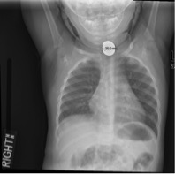 Choking!? Oh No! - Pediatric Foreign Body Ingestion - County EM