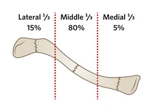 Clavicle Fracture - The Original Kings Of County