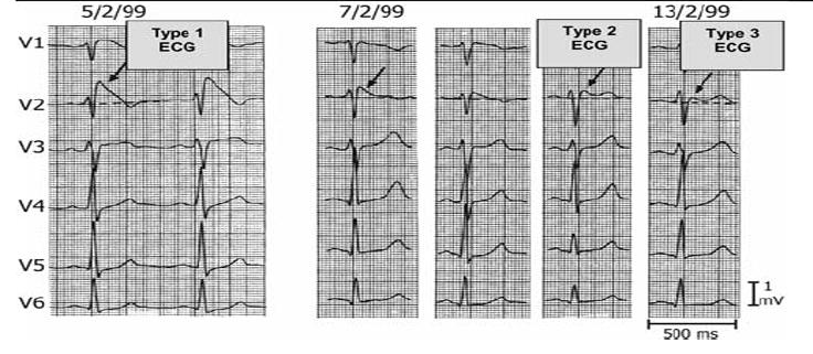 Brugada Types - County EM