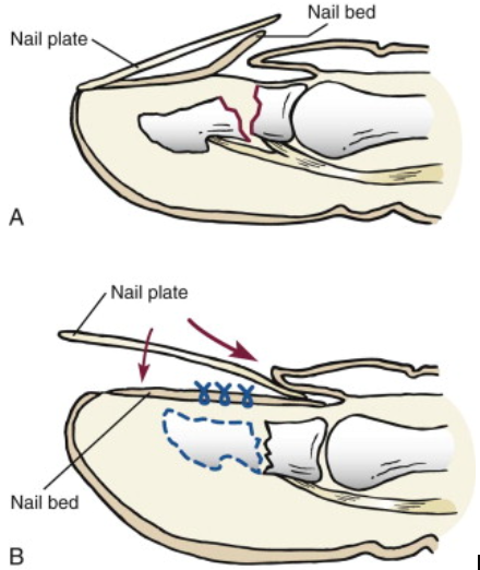 Nail Bed Laceration And Repair In The Emergency Department - County EM