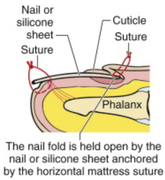 Nail Bed Laceration And Repair In The Emergency Department - County EM