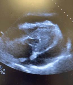 Emergent Pericardiocentesis - A Contemporary Review - County EM