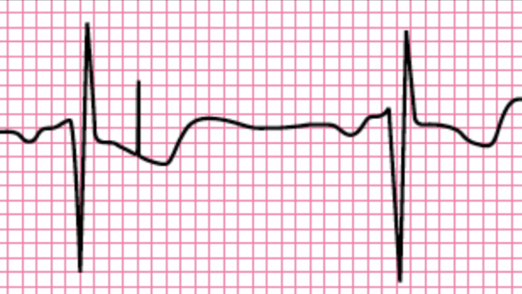 Interpreting A Paced Electrocardiographic Rhythm - County EM